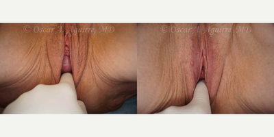 Case 9988 - 61 yo had Labia Majora Reduction,Vaginoplasty,Anal Tag Excision,Vaginal Hysterectomy,Vaginal Repair