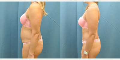 Case 999 - Woman treated with Tummy Tuck
