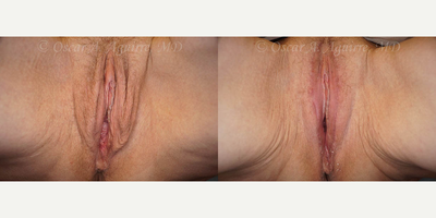 Case 9990 - 61 yo had Labia Majora Reduction,Vaginoplasty,Anal Tag Excision,Vaginal Hysterectomy,Vaginal Repair