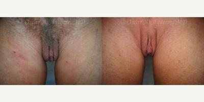 Case 9995 - 55 yo had Labiaplasty of Labia Minora/Majora,Clitoral Hood Reduction w/Clitoropexy,anal tag exc