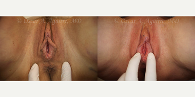 Case 9996 - 55 yo had Labiaplasty of Labia Minora/Majora,Clitoral Hood Reduction w/Clitoropexy,anal tag exc