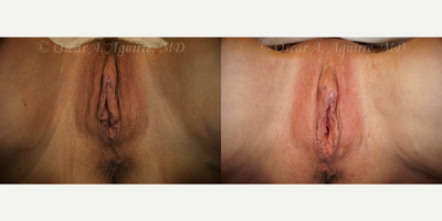 Case 9998 - 55 yo had Labiaplasty of Labia Minora/Majora,Clitoral Hood Reduction w/Clitoropexy,anal tag exc