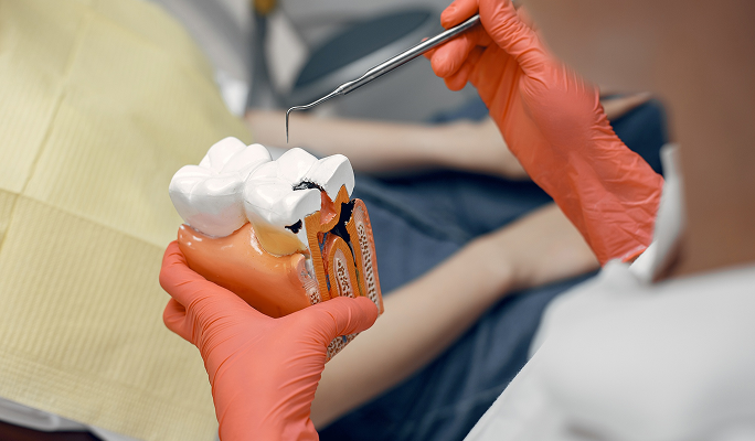 Root Canal