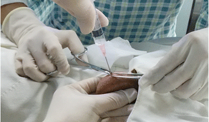 TESA (Testicular Sperm Aspiration)