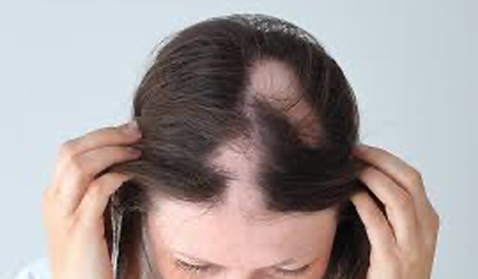 Alopecia