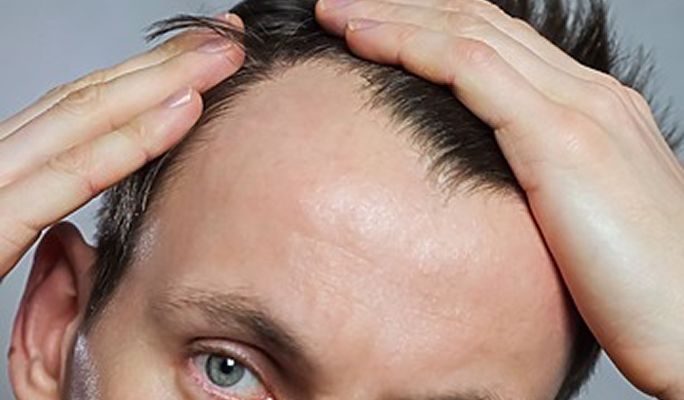 Scalp Reduction