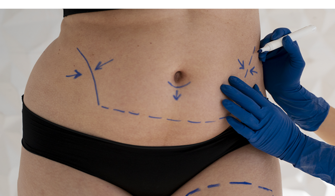 Lap Band Surgery