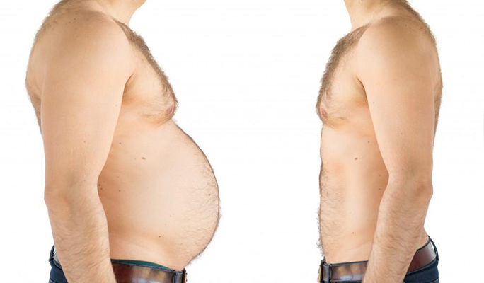 Sleeve Gastrectomy