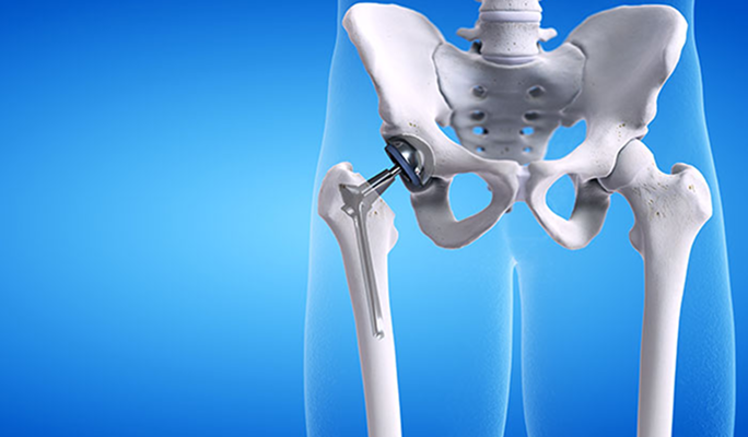 Proximal Hip Replacement