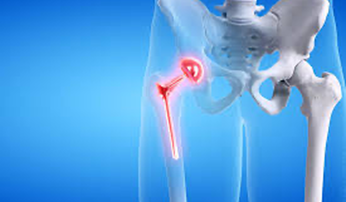 Hip Replacement Surgery Partial or Total