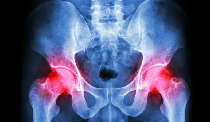 Hip Resurfacing Surgery