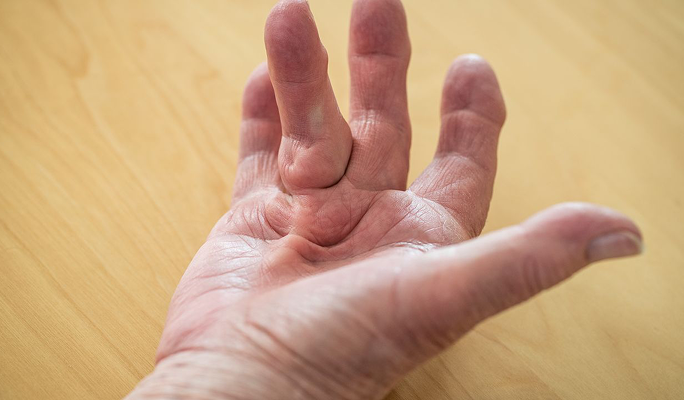 Dupuytrens Contracture Surgery