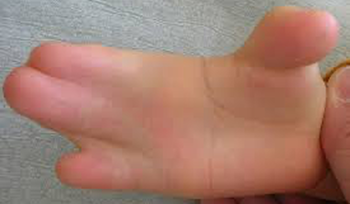 Webbed Finger Surgery