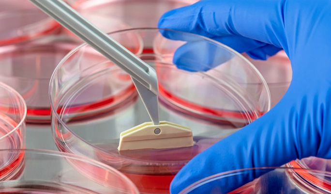 Stem Cell Infusion