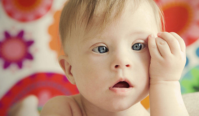 Stem Cell Treatment for Down Syndrome