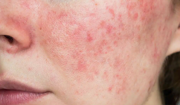 Stem Cell Therapy for Lupus