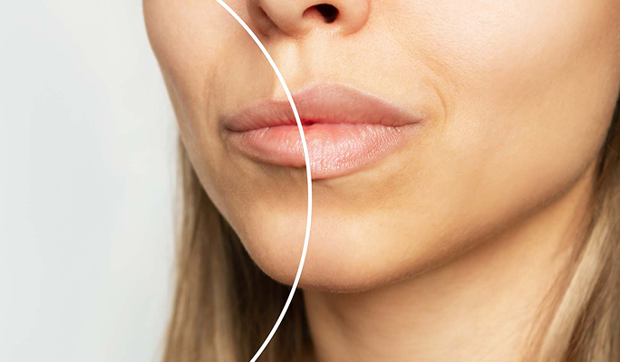 Cleft Lip Palate
