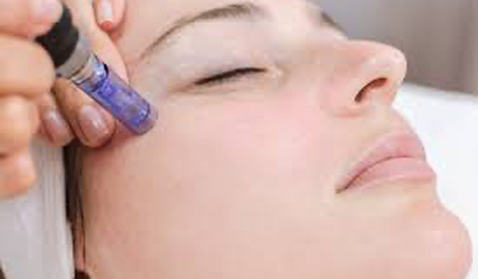 Microneedling