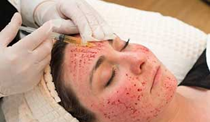 PRP Facial (Vampire Facial)