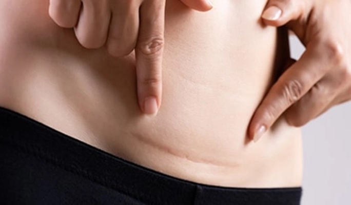 Stem Cell Therapy for Scars