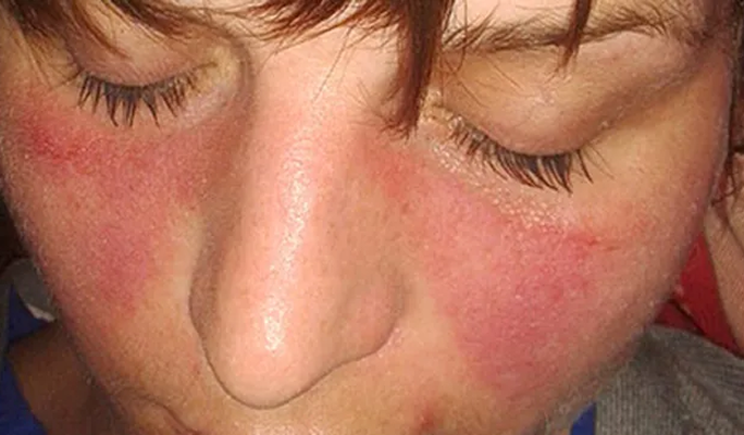 SLE (Systemic Lupus Erythematosus)