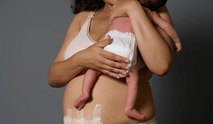 Caesarean section