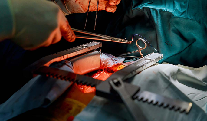 Heart Bypass Surgery