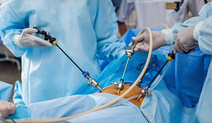 Laparoscopic Gallbladder Removal