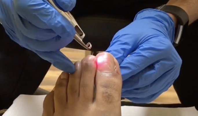 Fungus Toenail
