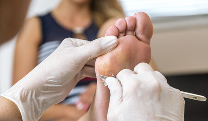 Calluses Treatment without Pain