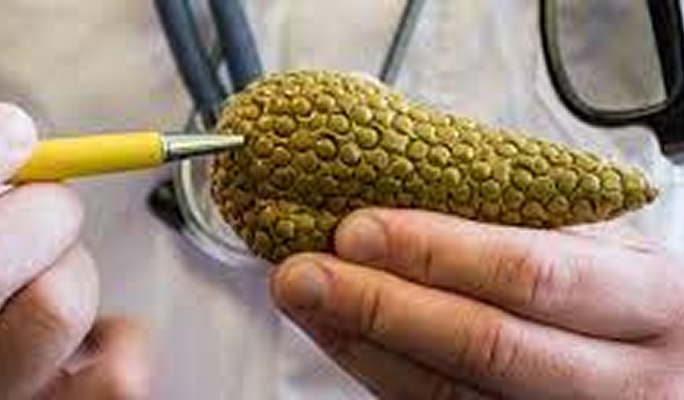 Pancreas Transplant