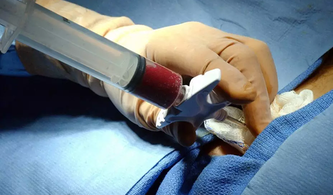 Hematopoietic Stem Cell Transplantation