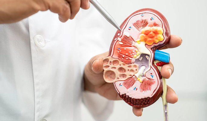 Kidney Stone Removal