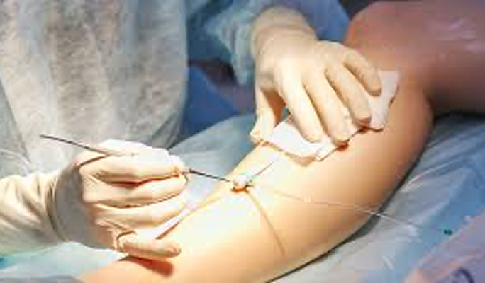 Ambulatory Phlebectomy