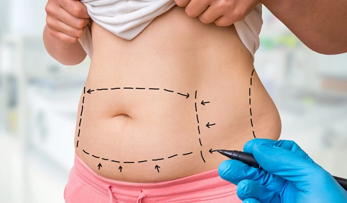 Abdominoplasty