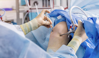 Arthroscopy