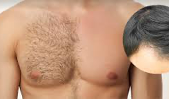 Body Hair Transplant
