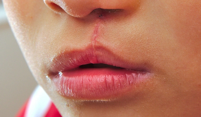 Cleft Lip Palate