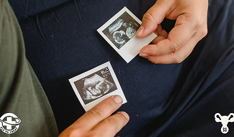 IVF with Embryo Donation and Gender Selection