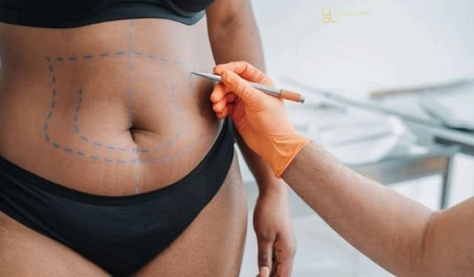 Liposuction