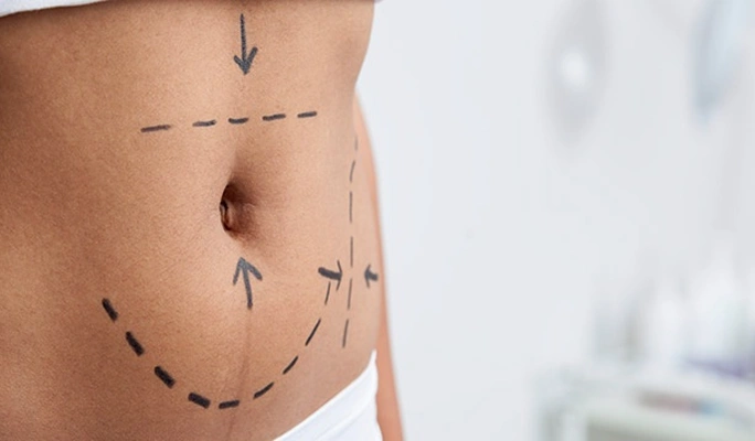 Mini Tummy Tuck