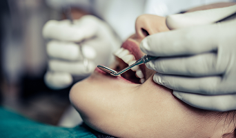 Surgical excision of gingival enlargement