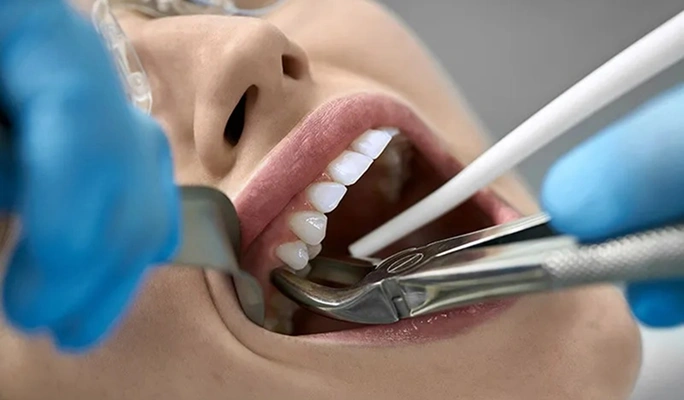 Tooth Extraction