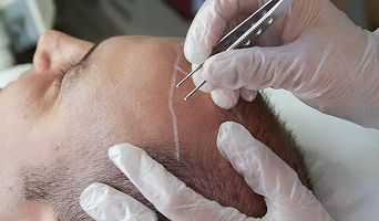 Hair Transplantation